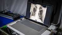 Ein Laptop, auf dem das Röntgenbild eines Oberkörpers zu sehe ist
